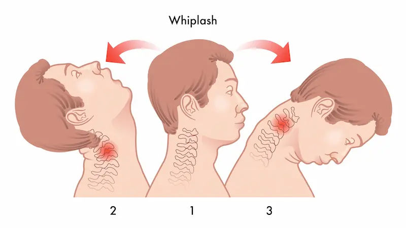 Whiplash Symptoms, Causes and Treatment Options